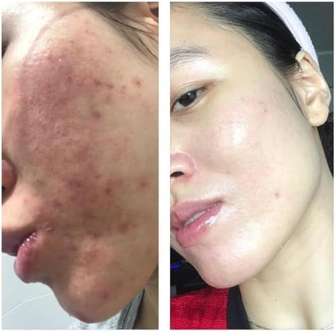 🌟 ASHAB AND SAFFRAN Skinoren Whitening Cream for All Skin Types – 30g